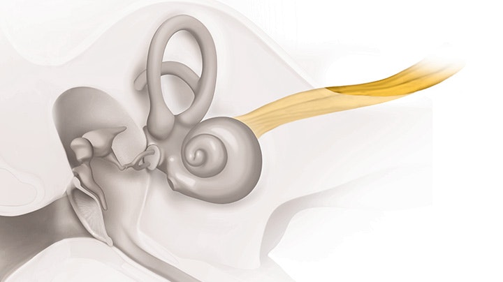 neurální-sluchová-vada