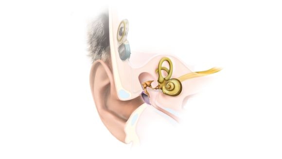 Spoľahlivý sluchový implantát pre každodenný život
