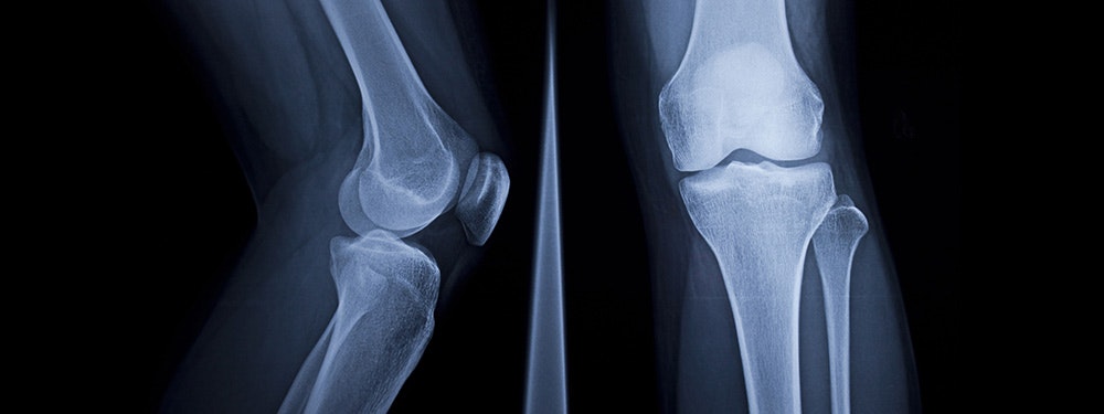 Diagnosis of gonarthrosis (knee arthrosis)