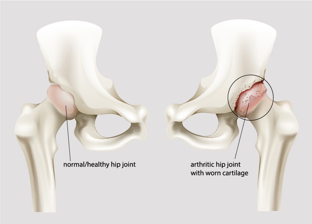 What is hip arthrosis?