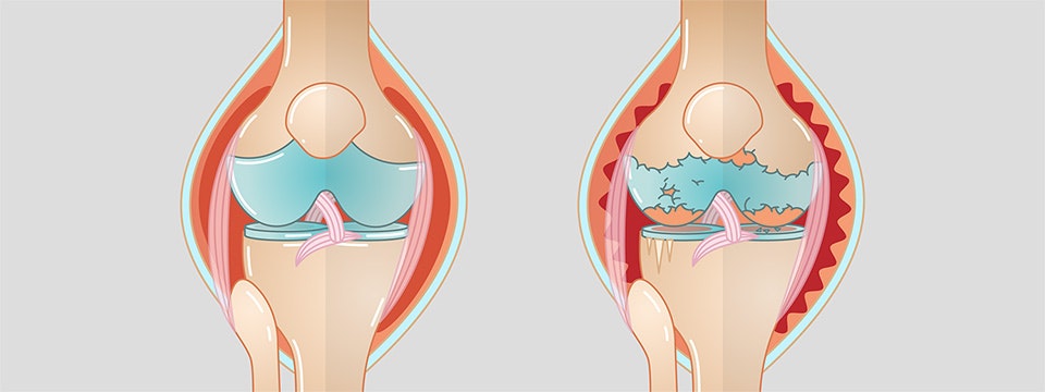 What is gonarthrosis (knee arthrosis)?